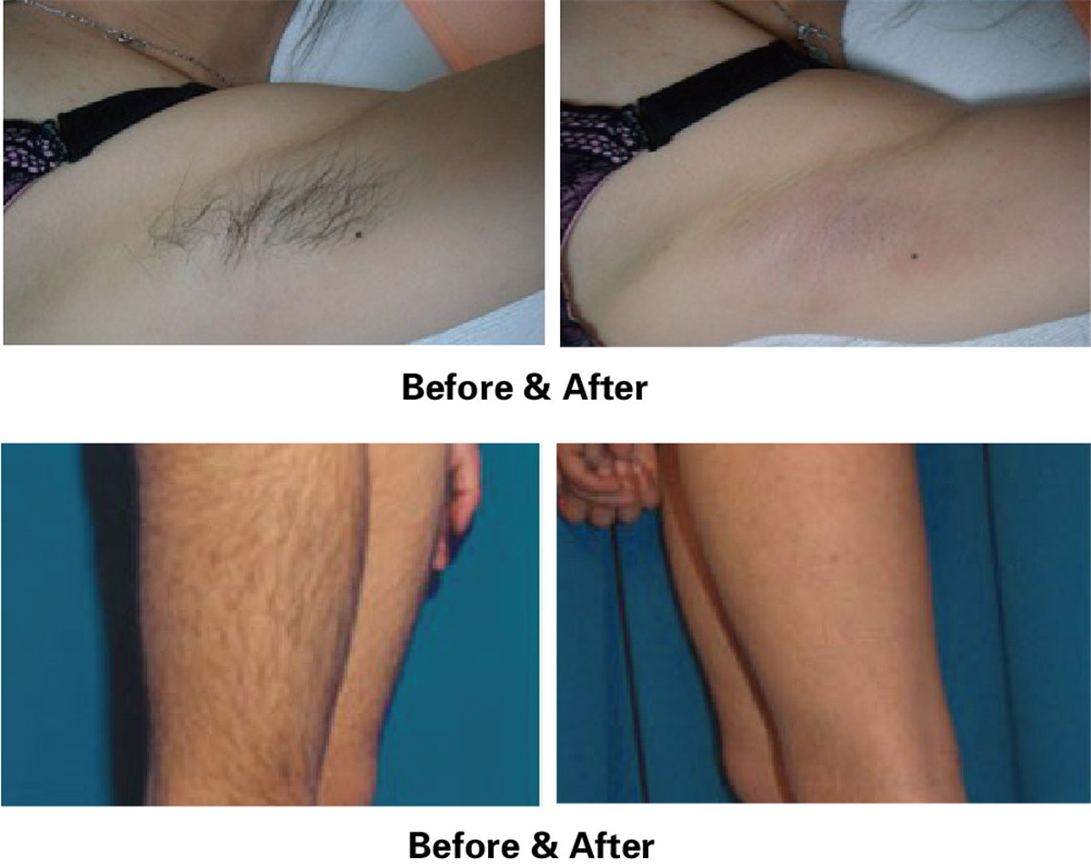 Hair Removal Center