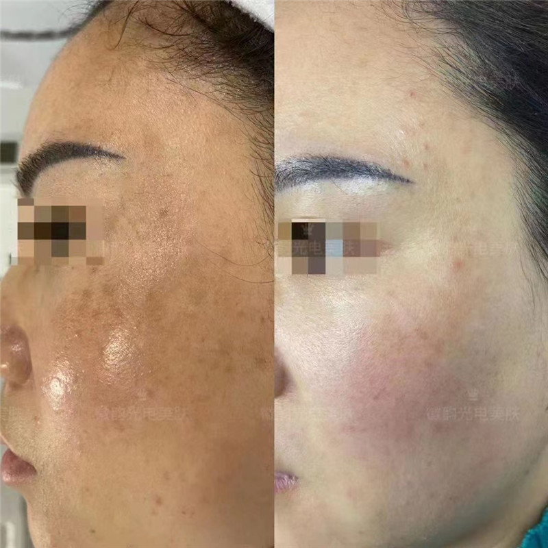 COMEY Post laser care skin care for pigmentation melasma removal laser tonging laser whitening (4)