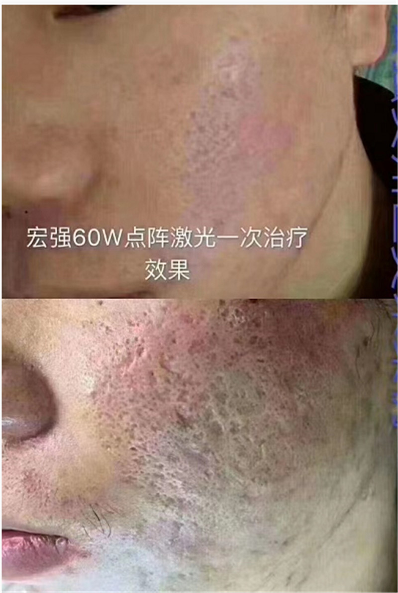 COMEY laser care for acne scar skin rebuilding skin youth collagen regeneration stretch marks (1)