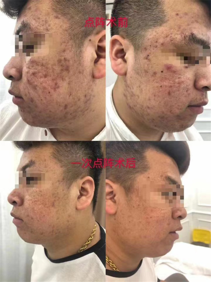 COMEY laser care for acne scar skin rebuilding skin youth collagen regeneration stretch marks (3)