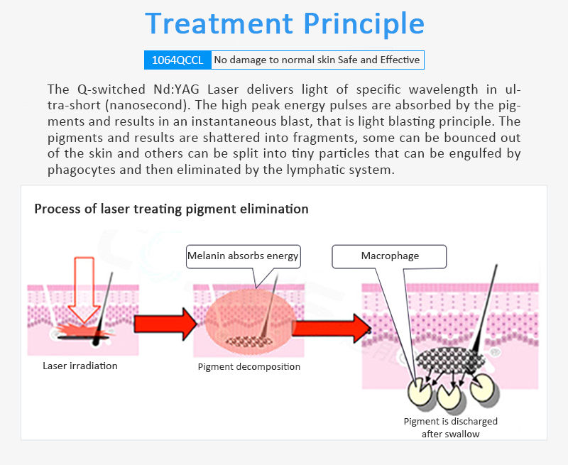 1064QCCL Q-Switched Nd:YAG Laser Pigment Lesions Tattoo Removal Vertical Machine