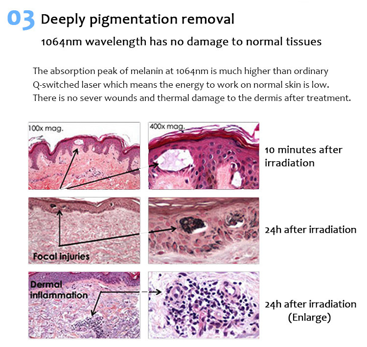 1064pvyl+ High Quality 1064nm & 532nm PicolaserPicosecond Laser Tattoo Removal Pigmentation Luxurious Equipment (7)