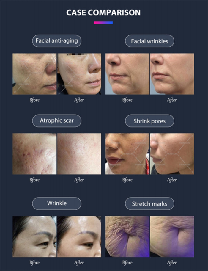 60watt Coherent CO2 fractional laser SM10600ZHb Skin Resurfacing Anti-Aging Scar Removal Vaginal Tightening (7)