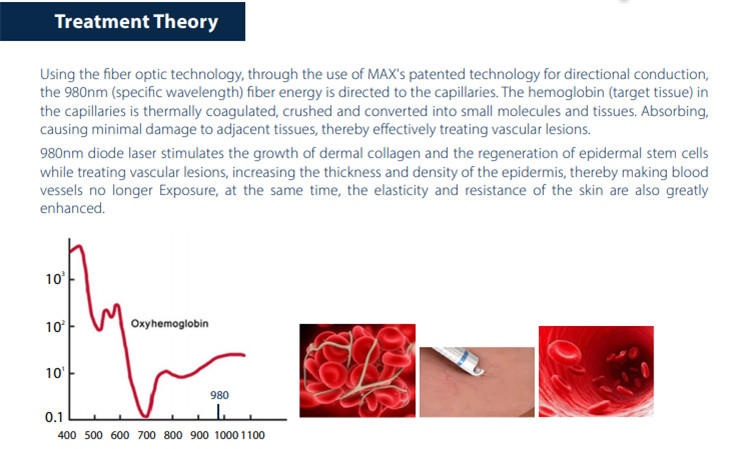 98onm Diode Laser For  Vascular Removal (2)