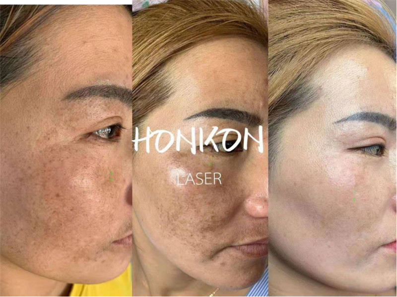 COMEY Post laser care skin care for pigmentation melasma removal laser tonging laser whitening (1)