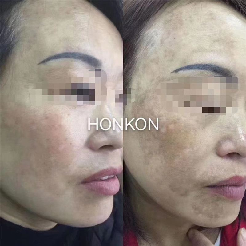 COMEY Post laser care skin care for pigmentation melasma removal laser tonging laser whitening (3)