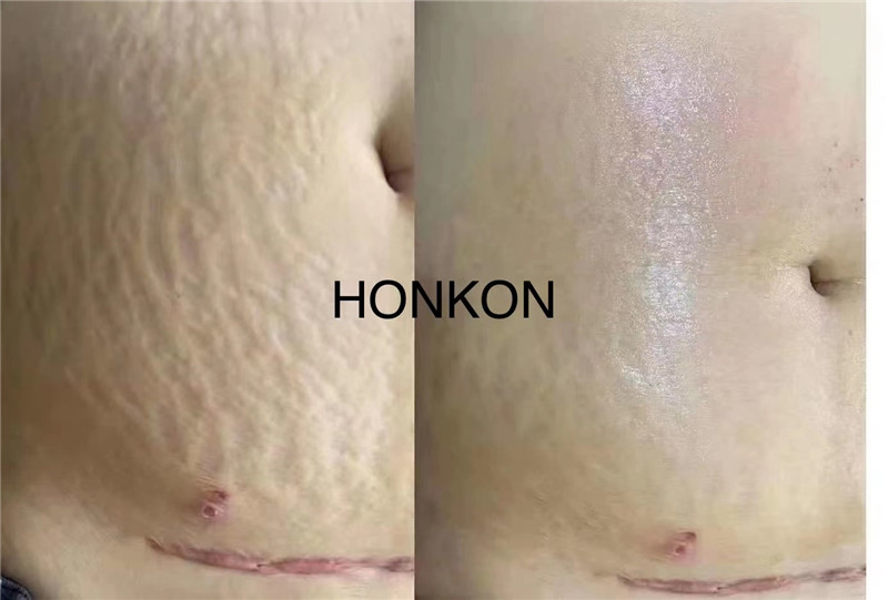 COMEY laser care for acne scar skin rebuilding skin youth collagen regeneration stretch marks (4)