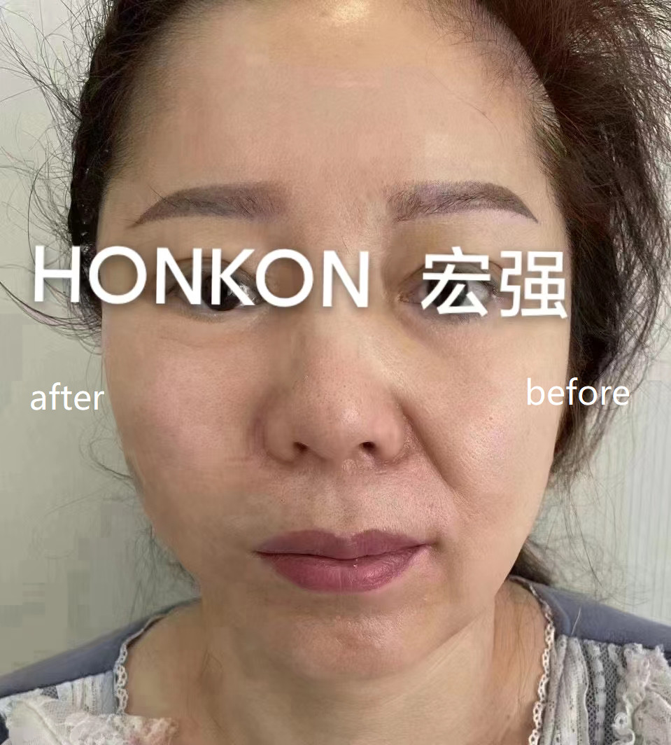 HIFU Skin Tightening Anti Aging Anti-wrinkle Machine (7)