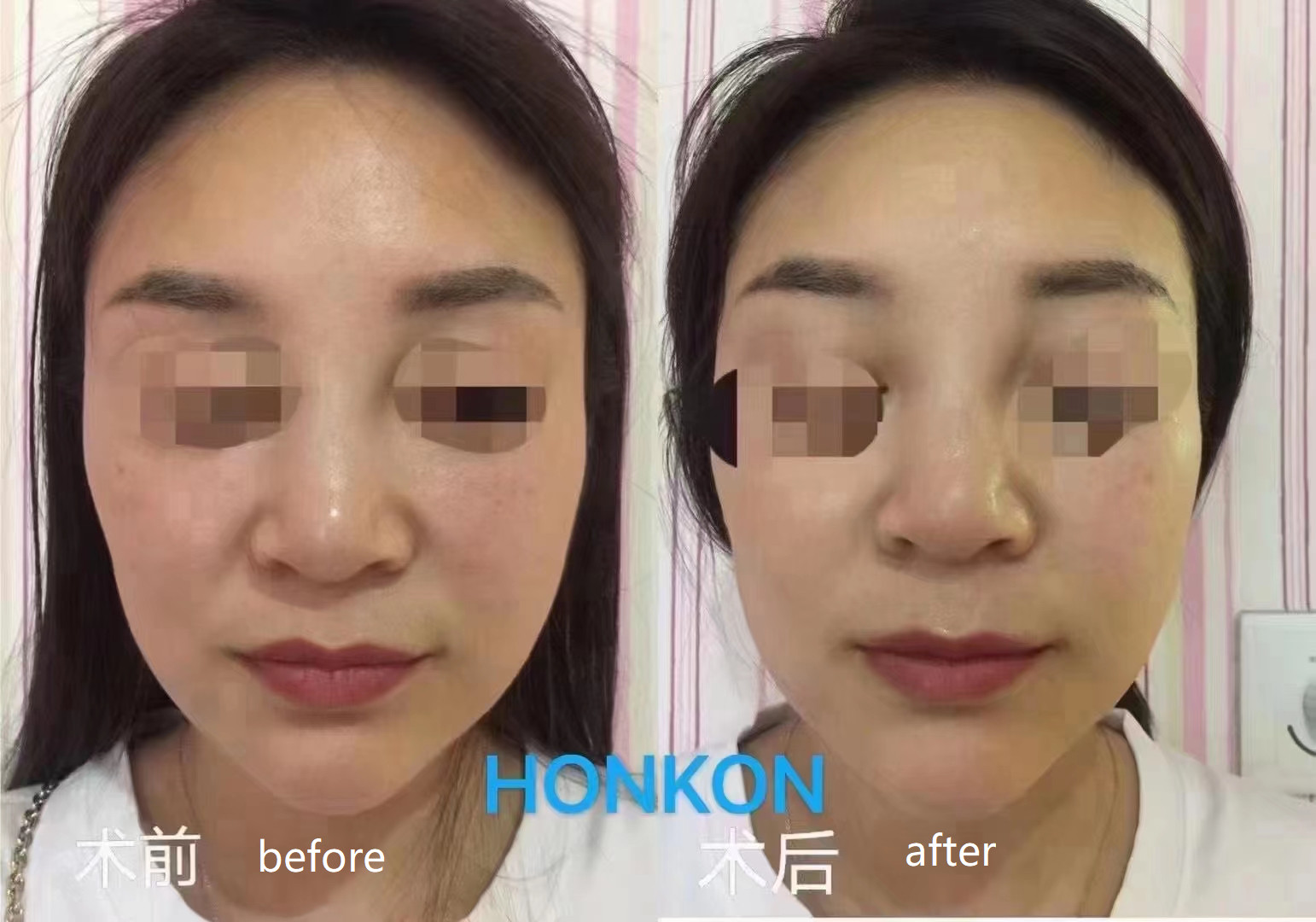 HIFU Skin Tightening Anti Aging Anti-wrinkle Machine (9)