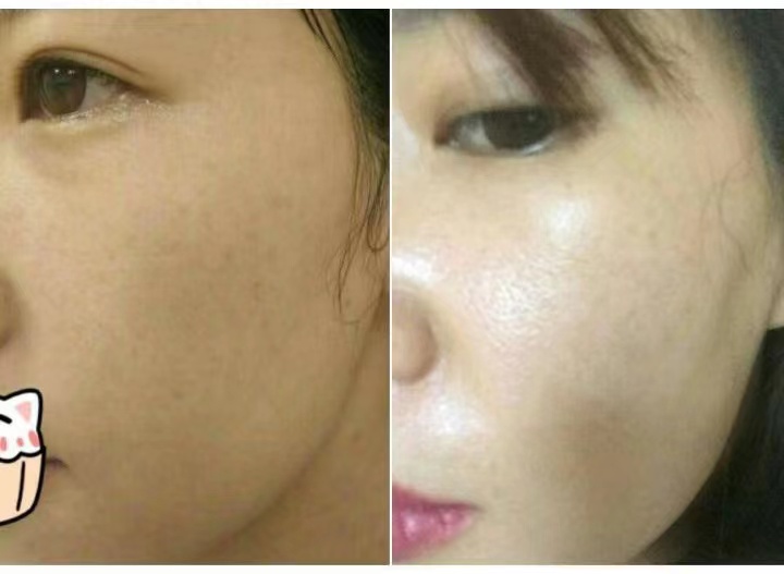 Skin care for carbon facial deep cleaning laser whitening acne removal oily skin (2)