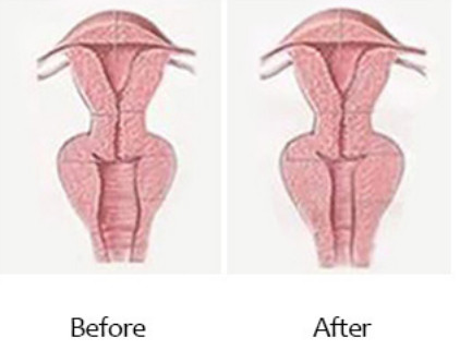 Portable HIFU Vaginal Tightening Non-Invasive Vaginal Treatment Beauty Machine
