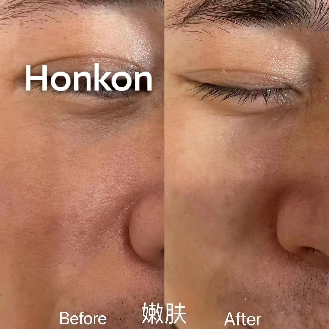 HONKON OPT SHR multi-function hair removal and skin rejuvenation